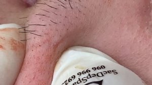 Выдавливание прыщей, угрей, черных точек и камедонов #18