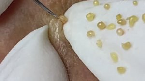 Relax Acne 013 • АСМР • Loan Nguyen collection