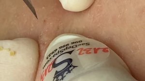 Выдавливание прыщей, угрей, черных точек и камедонов #22