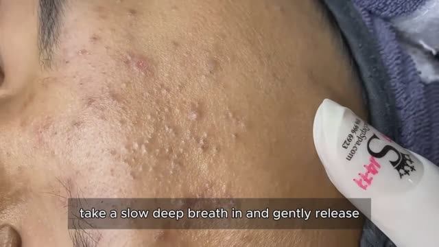 Чистим лицо от комедонов. Механический метод #𝟗𝟎523