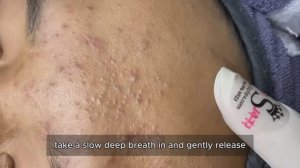 Чистим лицо от комедонов. Механический метод #𝟗𝟎523