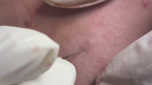 Лечение подкожных, воспалительных и кистозных прыщей