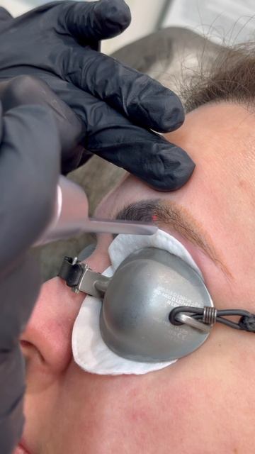 Удаление татуажа бровей лазером 🙌 Читай описание 👇