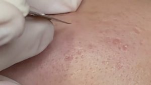 Удаление подкожных прыщей. Легко и просто!
