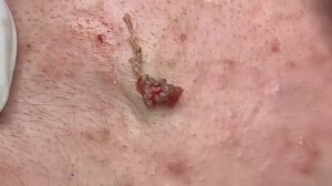 Прыщи, которые появляются из ниоткуда #прыщи #угри