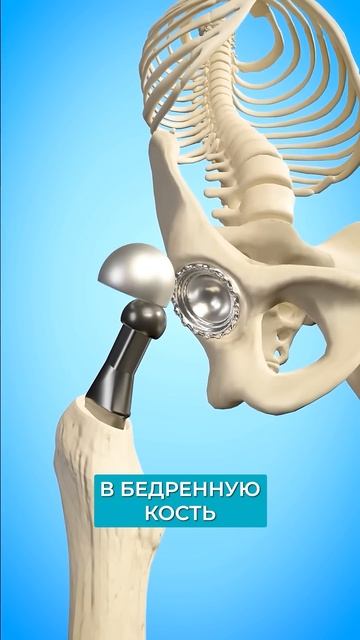 Как МЕНЯЮТ сустав? #сустав #тбс #здоровье смотреть онлайн