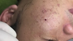 Избавление от прыщей в подростковом возрасте