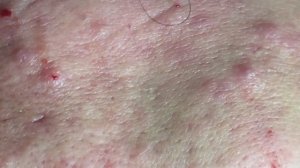 Лечение скрытых акне (комедонов). #комедоны #проблемнаякожа