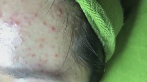 Прыщи (акне) у студентки из-за того, что мазала всякой ерундой.