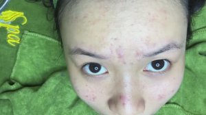 Удаление угрей (акне) у школьников. #угри #акне