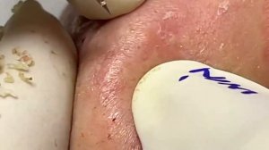 Выдавливание прыщей, угрей, черных точек и камедонов #26