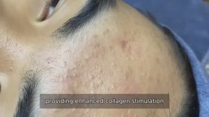 Asmr. Чистим кожу от черных точек. #𝟗𝟎536 #прыщи #угри #угреваясыпь