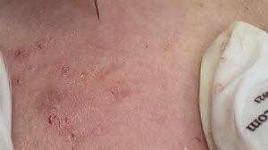 Акне / прыщи, скрытые глубоко под кожей