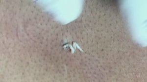 Профессиональное удаление акне #акне #постакне #механическаячистка