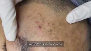 Asmr. Профессиональное очищение от черных точек. #𝟗𝟎538