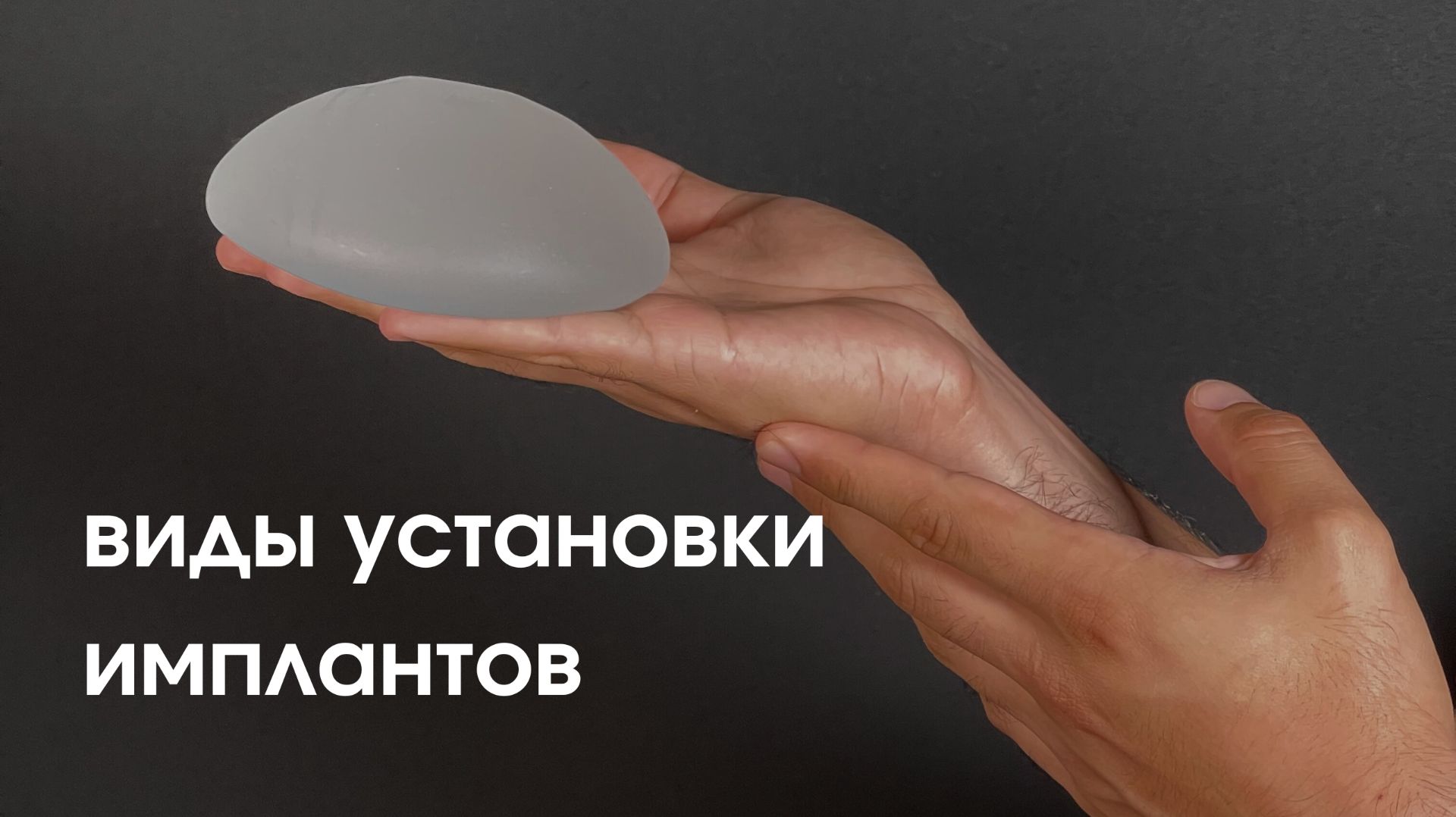 Всё о видах установки имплантов смотреть онлайн