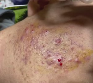 Лечение прыщей в 14 лет. Часть 6: невероятный результат