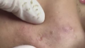 Чистка лица: работа с крупными открытыми и закрытыми комедонами