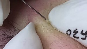 Relax Acne 016 • АСМР • Loan Nguyen collection