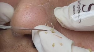 Удаляем въевшиеся черные точки с мужского лица | Remove Stubborn blackheads On Men's Skin