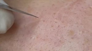 ВСЕ ВИДЫ ПРЫЩЕЙ! Белые точки и глубокие подкожники: удаление