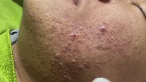 Лечение прыщей в 14 лет. Часть 5: невероятный результат