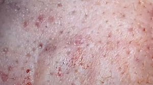 Выдавливание прыщей, угрей, черных точек и камедонов #31