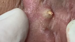 Прыщи за ушами. Устранение проблемы #прыщизаушами