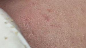 Удаление акне у молодой девушки #удалениеакне #механическаячистка