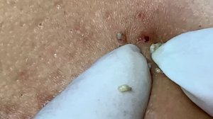 Гигантские черные точки: процесс удаления | Biggest blackheads removal
