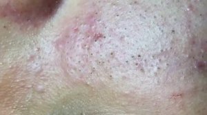 Выдавили черные точки! Море комедонов!