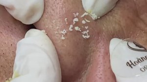 Очистка носа от сальных нитей. #сальныенити #удалениесальныхнитей