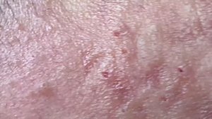 Быстрое избавление от черных точек | How to get rid of blackheads quickly