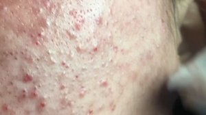 Лечение воспалительного акне для Мэй, часть 1, сессия 1