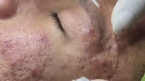 Лечение прыщей в 14 лет. Часть 1: невероятный результат