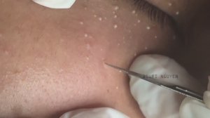 Аккуратное удаление милиумов в периорбитальной зоне: мастер-класс Suri Job 14