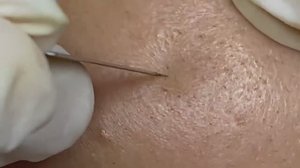 ГЛУБИННАЯ ЧИСТКА! Как достаем черные точки ИЗ-ПОД КОЖИ