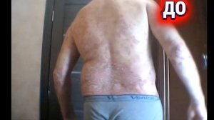 Псориаз ДО и ПОСЛЕ прослушивания программ МЭЦ