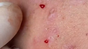 Выдавливание прыщей, угрей, черных точек и камедонов #32