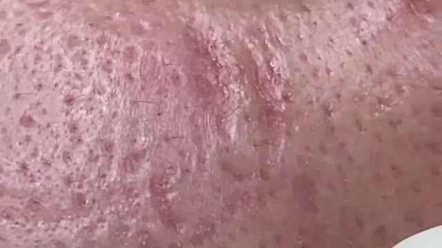 Asmr. Лечение подкожных угрей. #117 #угреваясыпь #удалениепрыщей смотреть онлайн