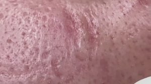 Asmr. Лечение подкожных угрей. #117 #угреваясыпь #удалениепрыщей