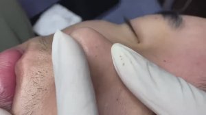 Relax Acne 017 • АСМР • Loan Nguyen collection