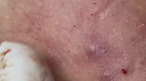 Чистка кожи от прыщей и черных точек: комплексный подход. #115