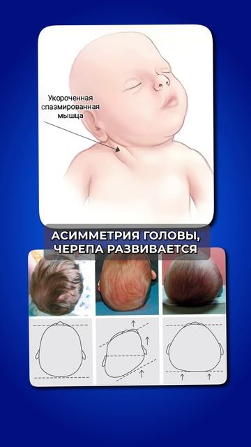 Ребёнок спит на животе с головой в одну сторону? Вот к чему это приводит #малыш #сон