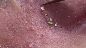 Asmr. Очищение кожи от черных точек. #119 #угреваясыпь #удалениепрыщей