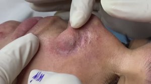 Глубокая чистка кожи от комедонов: результаты. #118