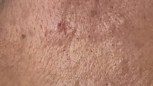 Asmr. Удаление прыщей и сальных пробок. #116 #черныеточки #чисткалица #проблемнаякожа смотреть онлайн