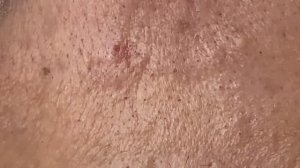 Asmr. Удаление прыщей и сальных пробок. #116 #черныеточки #чисткалица #проблемнаякожа