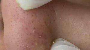 Удаление больших черных точек в носу