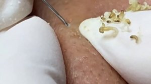 Выдавливание прыщей, угрей, черных точек и камедонов #35